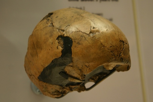 Neandertallerde Bilinen İlk Tüberküloz Vakası Keşfedildi
