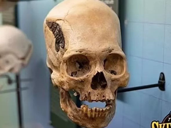 Kafatasındaki 2 bin yıllık metal plaka şaşırtıyor
