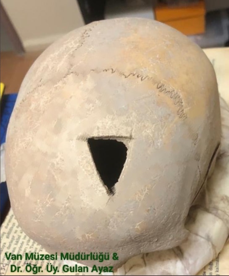 Aşıklı Höyük’ten sonra bir başka sıradışı trepanasyon (beyin ameliyatı) buluntusu Van’da keşfedildi