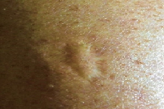 Mumyalar, Çiçek Hastalığını Avrupalıların Getirdiğini Kanıtladı