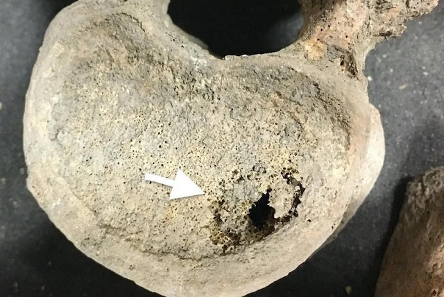 Orta Çağ İskeletlerine Göre Kanser Uzun Süredir Hayatımızda