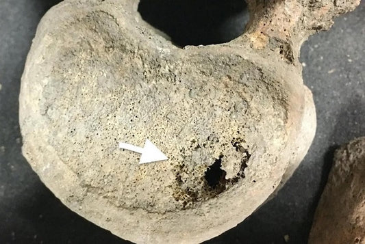Orta Çağ İskeletlerine Göre Kanser Uzun Süredir Hayatımızda