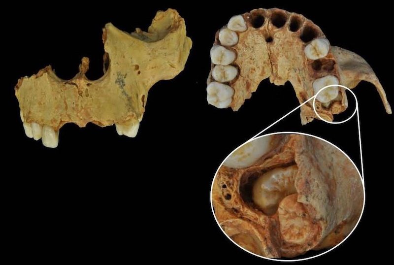 Homo antecessor’de Yirmilik Diş için Yeterli Boşluk Yoktu