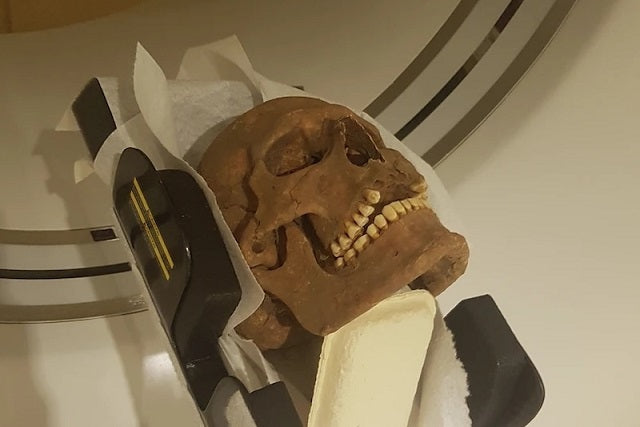 Viking Kafataslarında Ciddi Hastalık İzleri Ortaya Çıktı