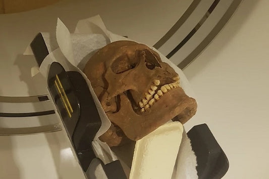 Viking Kafataslarında Ciddi Hastalık İzleri Ortaya Çıktı