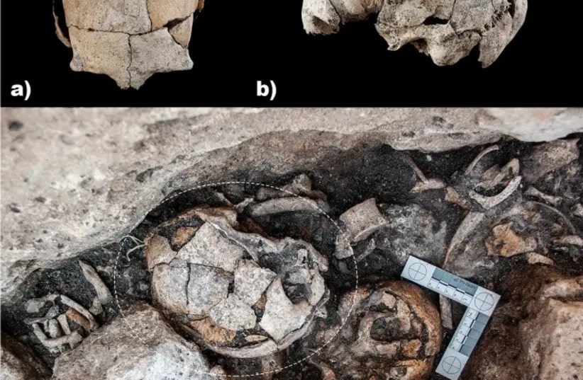 Arkeologlar, 5300 yıllık bir kafatasında bilinen ilk kulak ameliyatının kanıtlarını buldular.