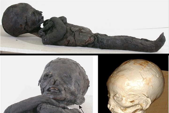 Mumyalanmış Antik Mısırlı Çocuklarda Anemi Yaygındı