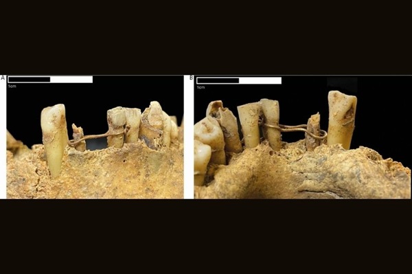 Orta Çağ Dişçiliği: İskoçya’nın İlk Altın Diş Köprüsü