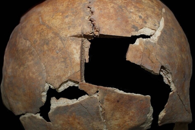 Bu Kişinin Kafasında 3.600 Yıl Önce Kare Delik Açılmış