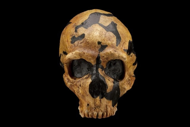 Bu Kafatası Bozukluğunun Nedeni Neandertal Genlerimiz Olabilir